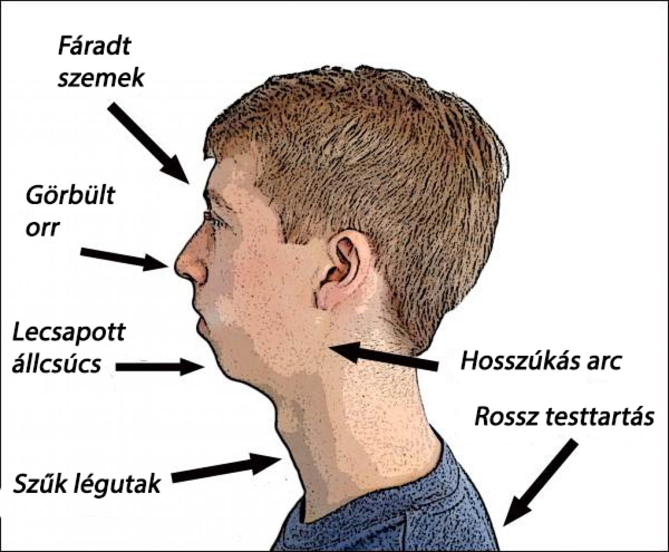 adenoid