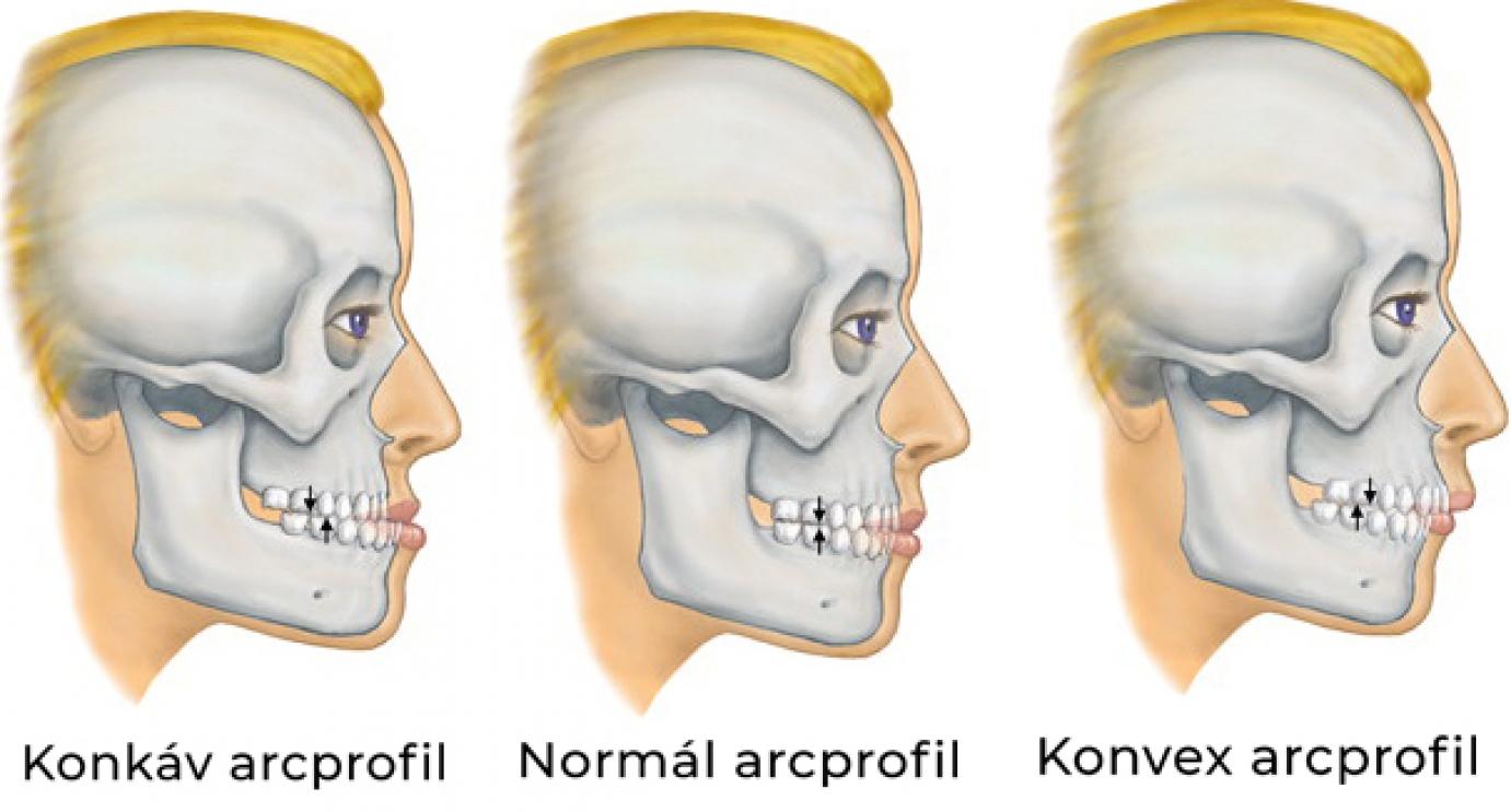 Arcprofil