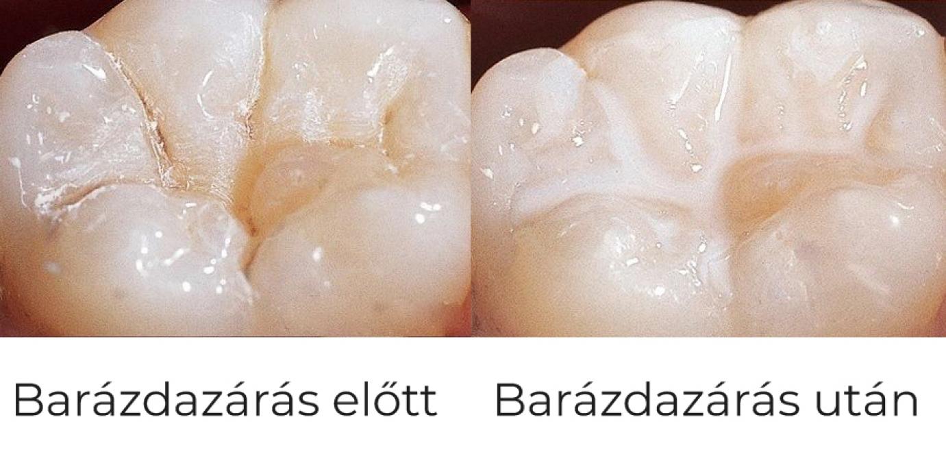 Barázdazárás
