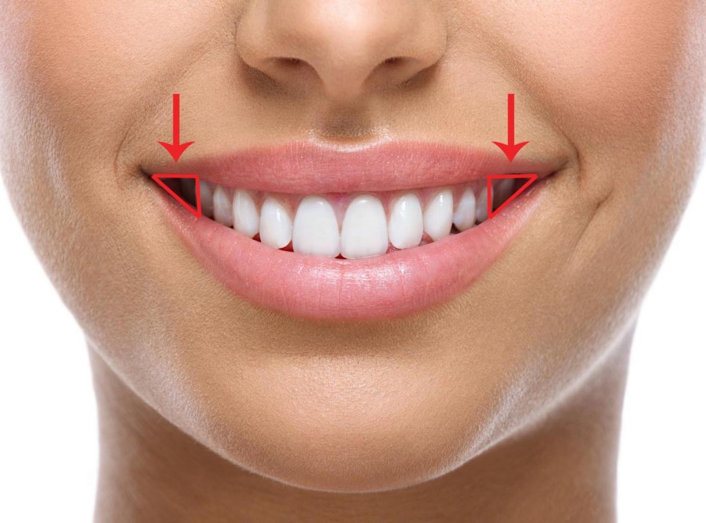 Buccal corridor