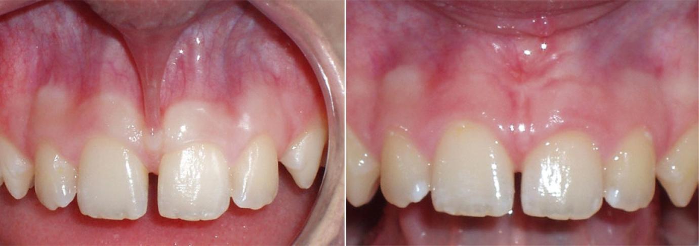 Frenulectomia