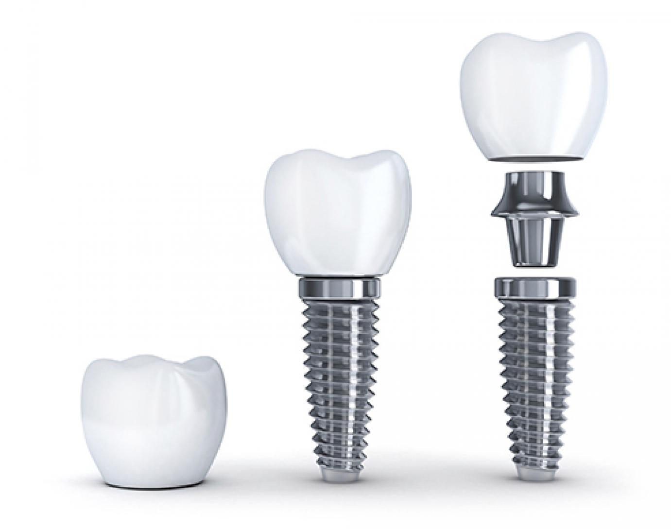 Implant