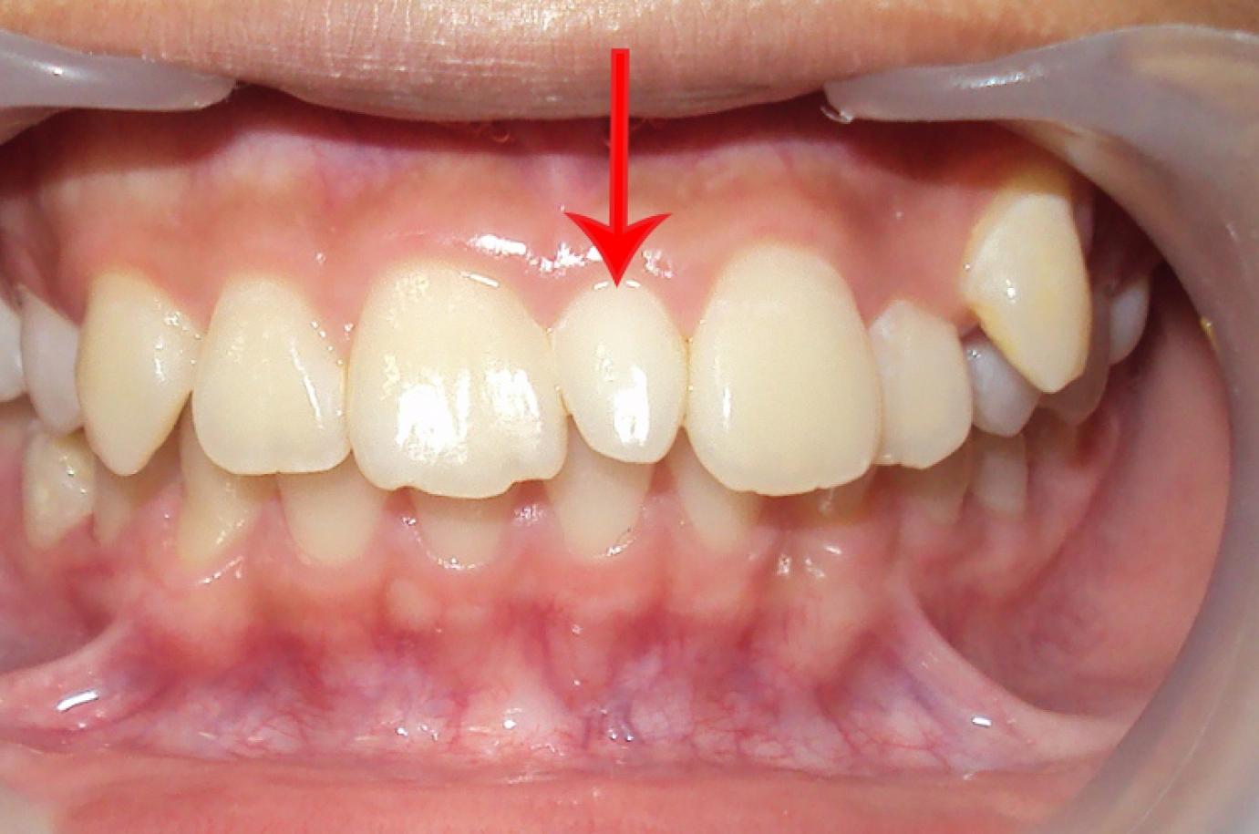Mesiodens