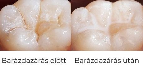 Barázdazárás